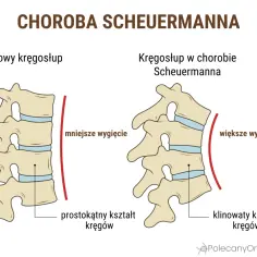 Porównanie zdrowego kręgosłupa z kręgosłupem w chorobie Scheuermanna. Widać klinowaty kształt kręgów i większe wygięcie przy tej chorobie.