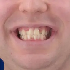 Uśmiech przed leczeniem Invisalign. Widoczne nierówne i lekko pożółkłe zęby.