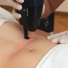 Jak się przygotować do laseru frakcyjnego, aby uniknąć problemów?