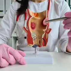Model jelita grubego z widocznymi zmianami, wskazującymi na hemoroidy zewnętrzne.