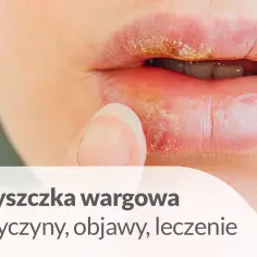 Zbliżenie na usta z widoczną opryszczką wargową. Dowiedz się, ile trwa opryszczka na ustach i jak ją leczyć.
