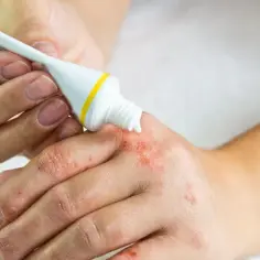 Osoba aplikuje dermovate maść na suchą, zaczerwienioną skórę dłoni.