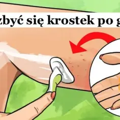 Jak pozbyć się krostek po goleniu - skuteczne metody i porady
