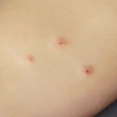 Skóra z kilkoma czerwonymi, swędzącymi zmianami, które mogą być **pluskwy ugryzienia**.