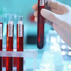 Jakie badanie krwi w kierunku Hashimoto pomoże w diagnozie?