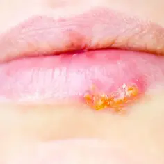 Pęcherzyki na ustach, objaw **herpes**, zaczerwienienie i strupki.