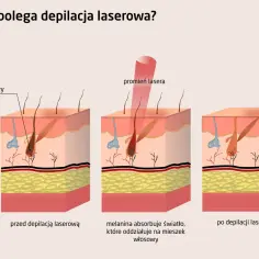 Ilustracja pokazuje, jak działa depilacja laserowa. Czy depilacja laserowa jest bezpieczna? Laser celuje w mieszek włosowy, niszcząc go.