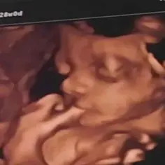 Trójwymiarowe USG pokazuje twarz dziecka, jego dłoń przy ustach. To agatowa echo serca, które bije w 28. tygodniu ciąży.