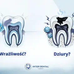 Ból zęba przy gryzieniu? Wrażliwy ząb po lewej, z próchnicą i bakteriami po prawej.
