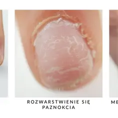 Wolny brzeg paznokcia - co to jest i jak dbać o zdrowie paznokci