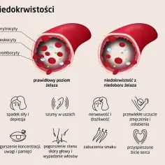 Porównanie poziomu żelaza: prawidłowy vs. niedobór. Objawy anemii: bladość, zmęczenie, szumy w uszach, bóle głowy.