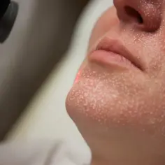 Laser frakcyjny CO2 ablacyjny czy nieablacyjny - co wybrać dla skóry?