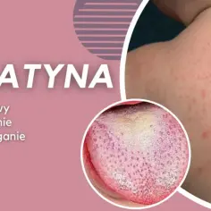 Szkarlatyna: objawy, leczenie i zapobieganie. Widoczna wysypka na skórze i nalot na języku.