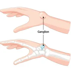 Ilustracja dłoni z widocznym zgrubieniem (ganglion) na nadgarstku oraz przekrój pokazujący jego położenie względem kości.
