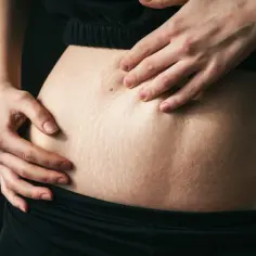 Dłonie dotykają brzucha z widocznymi rozstępami, ukazując jego naturalny wygląd po cesarce.