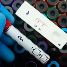 Rękawiczka w niebieskiej rękawiczce trzyma probówkę z napisem "CEA". Obok leży test paskowy z dwoma czerwonymi liniami, wskazujący wynik badania CEA.
