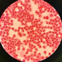 Mikroskopowy obraz ukazujący liczne białe krwinki i bakterie Neisseria gonorrhoeae, odpowiedzialne za rzeżączkę.