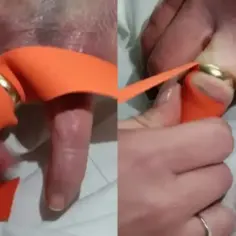Pomoc w zdjęciu pierścionka z bardzo spuchniętego palca przy użyciu pomarańczowej wstążki.