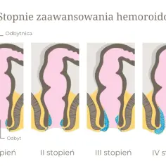 Ilustracja pokazuje stopnie zaawansowania hemoroidów, od I do IV. Widoczne są zmiany w obrębie odbytu i odbytnicy, które wyjaśniają, od czego są hemoroidy.