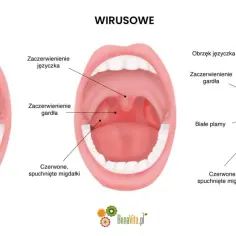 Porównanie gardła: normalne, wirusowe i bakteryjne. Białe naloty na migdałkach mogą wskazywać na paciorkowcowe zapalenie gardła.