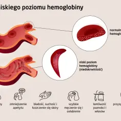 Niski poziom hemoglobiny powoduje, że erytrocyty przybierają sierpowaty kształt, co prowadzi do bólu głowy, bladości i zmęczenia.