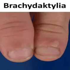 Zbliżenie na dwa palce dłoni z widocznymi krótkimi paznokciami i skórkami, ilustrujące brachydaktylię.
