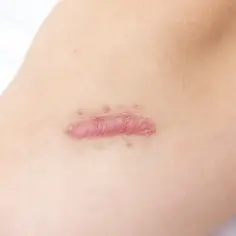 Widoczny na skórze różowy, wypukły keloid, który powstał po urazie.