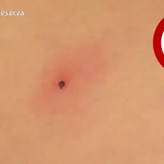 Jak wygląda mały kleszcz? Rozpoznaj go i uniknij niebezpieczeństwa!