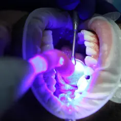 Dentysta utwardza światłem lampy nowe plomby w jamie ustnej pacjenta.