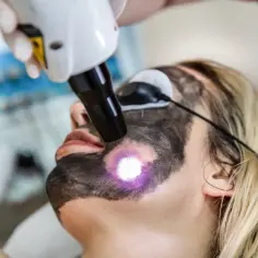 Zabieg laserowy peeling węglowy przed i po. Skóra twarzy pokryta maską węglową, na którą skierowany jest promień lasera.