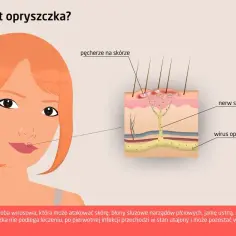 Początek opryszczki na ustach. Schemat pokazuje wirusa opryszczki w nerwie skórnym, prowadzącego do pęcherzy.