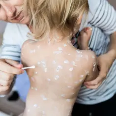 Mama smaruje ospę u dziecka, by ulżyć w swędzeniu. Pielęgnacja skóry z wykwitami.