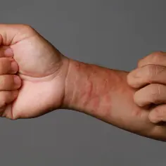 Czerwone, swędzące zmiany skórne na przedramieniu, objawy azs na dłoniach.