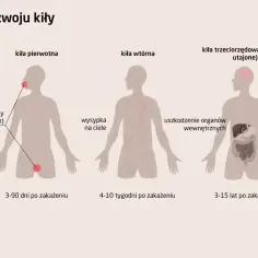 Ilustracja przedstawia stadia rozwoju kiły: pierwotne (wrzód), wtórne (wysypka) i trzeciorzędowe (uszkodzenie organów wewnętrznych, np. mózgu i wątroby).