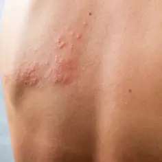 Jak wygląda alergia? Objawy i charakterystyka reakcji skórnych