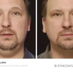 Przed i po zabiegu lipolizy: widoczna redukcja tkanki tłuszczowej i obkurczenie skóry na twarzy mężczyzny.