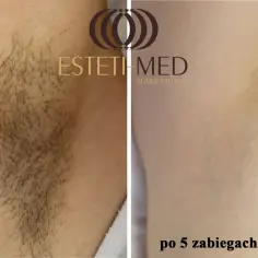 Przed i po 5 zabiegach depilacji laserowej pach. Widoczna redukcja owłosienia.