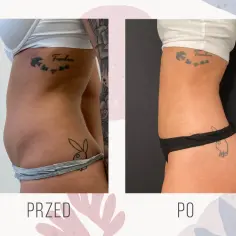 Na czym polega liposukcja? Poznaj skutki i metody tego zabiegu