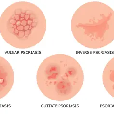 Różne formy łuszczycy: plackowata, odwrócona, krostkowa, kropelkowata i erytrodermia łuszczycowa.