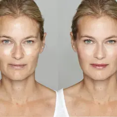 Ile kosztuje botox na czoło? Ceny w Polsce i co warto wiedzieć