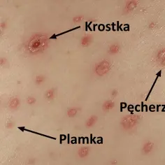 Widok skóry dziecka z objawami ospy: plamki, krostki i pęcherzyki.