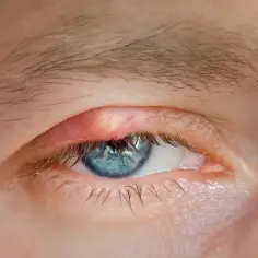 Widoczne kępki żółte na powiece, obok niebieskiego oka.