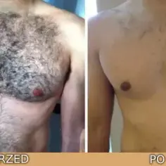 Co to jest epilacja i jak skutecznie usunąć niechciane owłosienie?