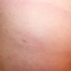 Skóra z przebarwieniami i zaczerwienieniami, może wymagać konsultacji w sprawie borelioza leczenie.