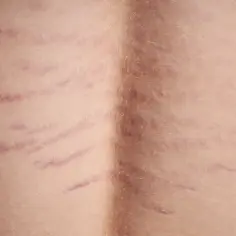 Widoczne rozstępy na plecach, świadectwo zmian zachodzących w ciele.