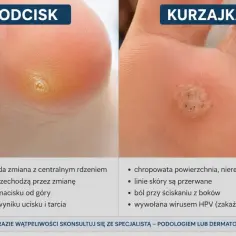 Porównanie kurzajki i odcisku na stopie. Kurzajka jest chropowata i wywołana wirusem, a odcisk gładki i powstaje od ucisku.