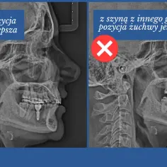 Rentgen żuchwy: po lewej bez szyny, pozycja lepsza. Po prawej z szyną na staw skroniowo żuchwowy, pozycja gorsza.