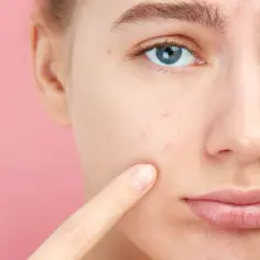Jakie badania hormonów przy trądziku mogą zmienić Twoje leczenie?