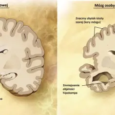 Porównanie mózgu zdrowego i z chorobą Alzheimera. Ubytek kory mózgowej i hipokampa, wzrost komór. Rywastygmina może pomóc w łagodzeniu objawów.