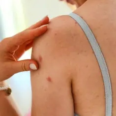 Dłoń dotyka ramienia z widocznymi zmianami skórnymi, które mogą przypominać łupież Gilberta.